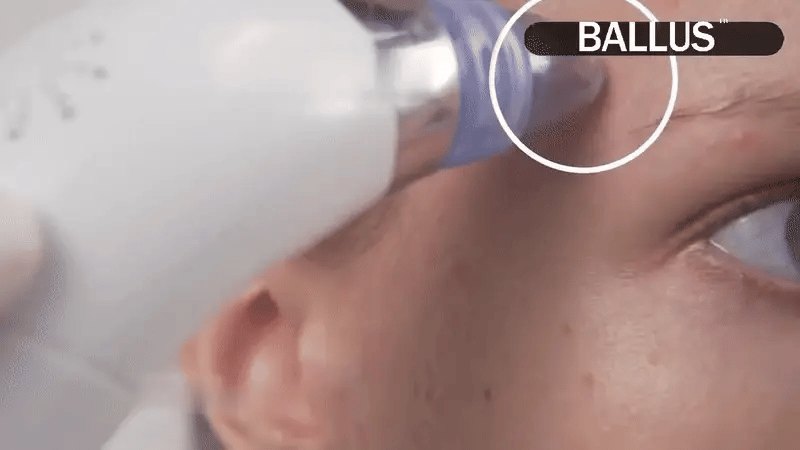 5-in-1 Pore Vacuum Cleaner & Blackhead Remover Tool (5 Suction Levels & 4 Probes)